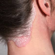 psoriasis aloe vera
