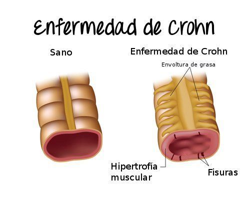aloe vera en la enfermedad de crohn